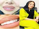 نمونه جرمگیری زیر لثه ای با اولتراسونیک (13) | بهترین دندانپزشک اصفهان