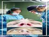جراحی زیبایی بینی دکتر مهرداد مقیمی بینی گوشتی