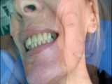جراحی سینوس و اندو کردن دندان در حین عمل  . دکتر مهدی سطوتی