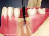 طول درمان ایمپلنت دندان چقدر است؟ / دکتر زهرا راستگو
