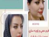 فرم دهی چانه و رفع غبغب