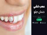  نحوه درآمدن دندان شیری به چه صورت است؟ 