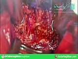 فیلم جراحی دیسک گردن توسط دکتر محمدرضا گمرکی