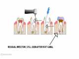 endodontics in elderly patients