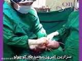 فیلم عمل سزارین دو قلوها توسط دکتر سلیمی