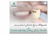 رفع پوسیدگی دندان و استفاده از لمینت برای زیبایی دندان های بیمار