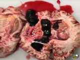 کالبدشکافی مغزی که خونریزی کرده