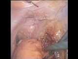 Transverse Colon Anastomosis with spray