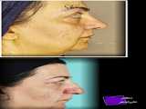 جراحی بینی به سبک دکتر شیرازی