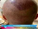 زراعة الشعر