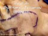 لیفت و جوانسازی دور لب با نخ