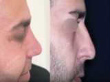یک ماه بعد از جراحی بینی گوشتی