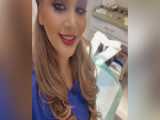 کاشت مو بعد از ۸ماه