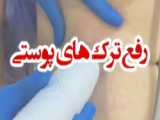 رفع لک های پوستی تنها بعد از یک جلسه لیزر آمریکایی فرکسل