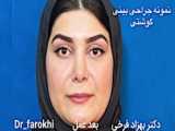 جراحی بینی بسیار گوشتی