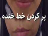 پر کردن خط خنده و خط غم با تزریق ژل
