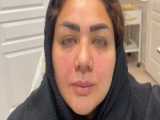 خط خنده و فیلر زیر چشم | Metagod