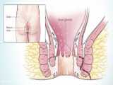 فیستول مقعدی چگونه درمان می شود؟