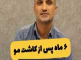 کاشت مو بعد از 6 ماه