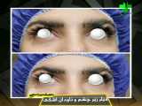 فیلر چشم