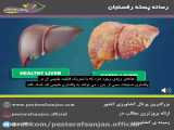 دلایل کبد چرب و عوارض آن و پک برطرف کننده ی کبد چرب