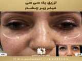 تزریق فیلر زیر چشم در شیراز