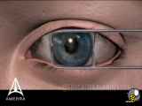 عمل جراحی لیزینگ چشم