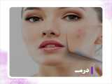 جدیدترین روش درمان آکنه صورت