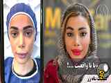 تزریق چربی از رویا تا واقعیت ( کلینیک زماه زر )