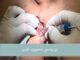 فیلم جراحی بواسیر با تیغ