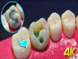 نجات دندان با پوسیدگی گسترده امکان پذیر است /ترمیم دندان بشدت پوسیده