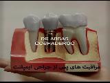 مراقبت های پس از کاشت ایمپلنت دندان