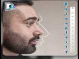 1 ماه پس از جراحی بینی