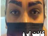 جراحی کاشت ابرو تنها در 10 دقیقه