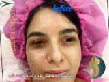 جراحی بینی و رفع انحراف