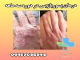 درمان پسوریازیس اگزما و پیسی