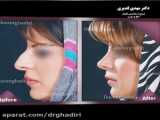 قبل و بعد از جراحی زیبایی بینی در اصفهان