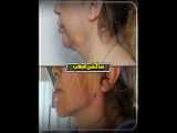 ساکشن غبغب فوق‌العاده برای مشتری عزیز