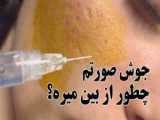لیفت صورت با تزریق فیلر