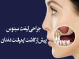 جراحی لیفت سینوس در ایمپلنت دندان | متخصص ایمپلنت اصفهان