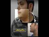 ساکشن غبغب فوق‌العاده برای مشتری عزیز