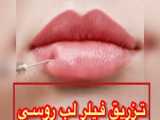 تزریق فیلر لب در کرج