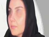 جراحی زیبایی بینی با اصلاح قوز و افتادگی نوک بینی