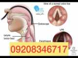 مشاهده رفلاکس حنجره ای با استروبوسکوپی |۰۹۳۳۷۸۰۱۳۷۹ دکتر دشتله