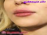 تزریق ژل لب تخصصی و زیبا