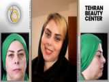بلفاروپلاستی یا جراحی زیبایی پلک در کلینیک سیب شیراز