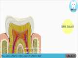 نحوه ترمیم پوسیدگی دندان در دندانپزشکی - ترمیم ریشه - عصب کشی