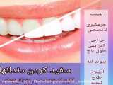 عمل بلچینگ و لمینت و مرتب سازی دندان در مطب دکتر عمادزاده
