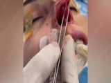 برداشتن گچ یک هفته پس از جراحی بینی