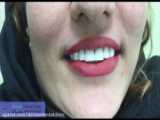 فیلم ایمپلنت دندان و رضایت بیمار از خدمات دندانپزشکی ولیعصر دنتال